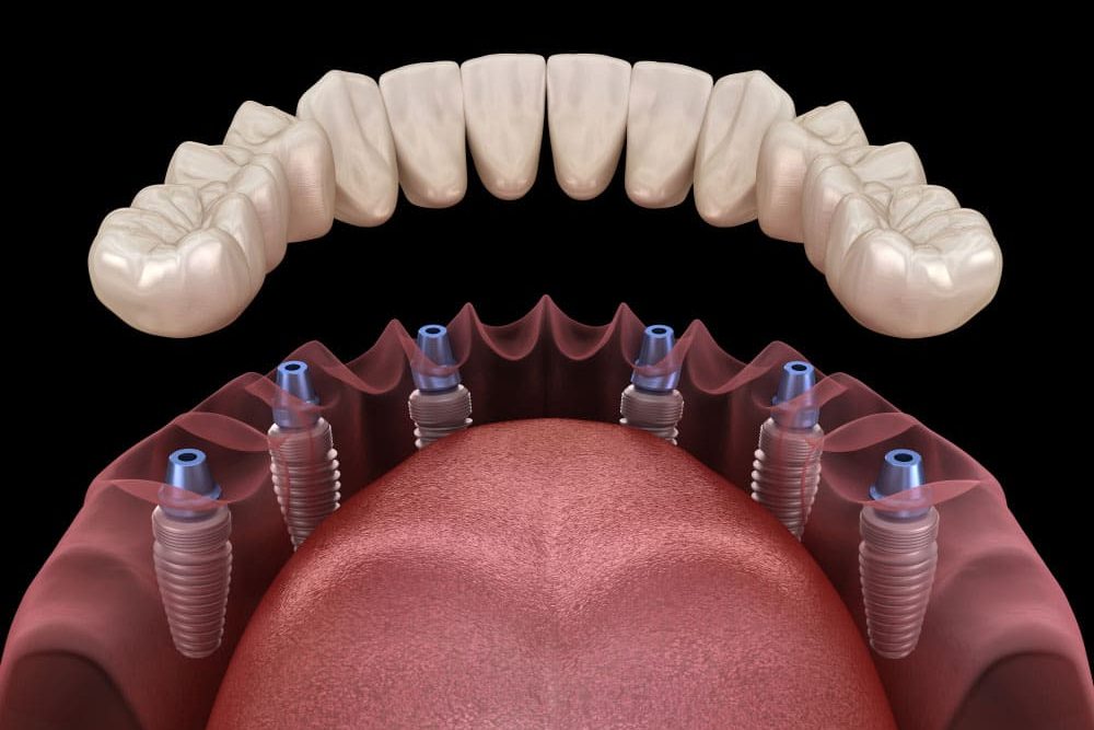 All-on-4 implant sistemiyle desteklenen tam çene protezi