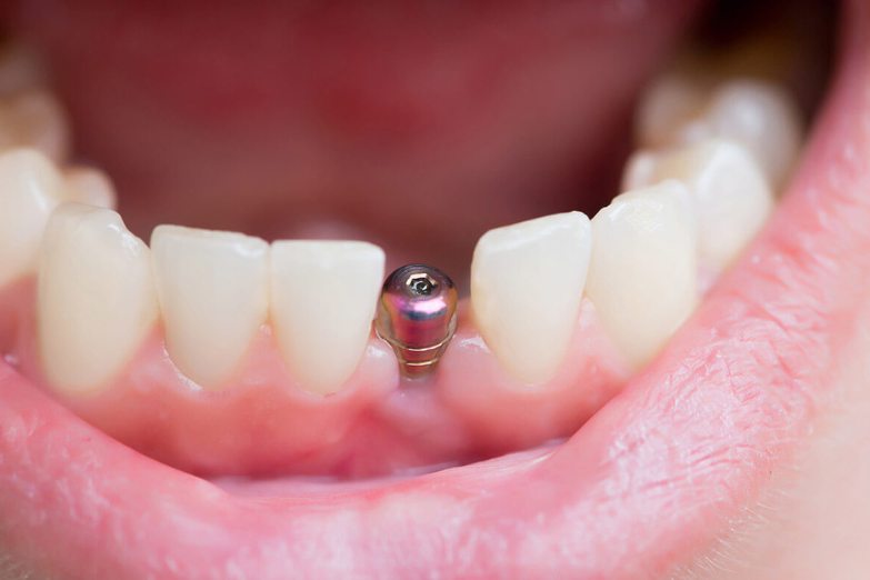 Diş etine yerleştirilmiş implant dayanağı